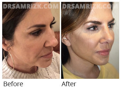 Female face, before and after Facelift, side view, patient 48