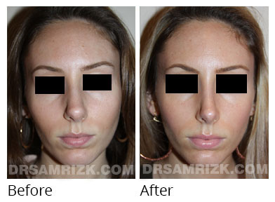 Female face, before and after Rhinoplasty treatment, front view, patient 62