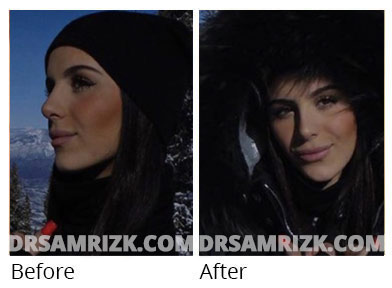 Female face, before and after Rhinoplasty treatment, side view, patient 70
