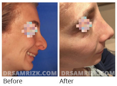 Female face, before and after Rhinoplasty treatment, side view, patient 72