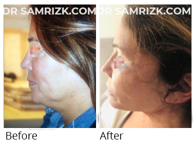 Female face, before and after Facelift and necklift treatment, front view, patient 48