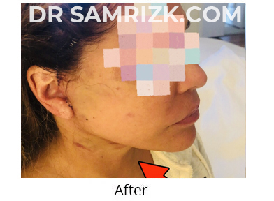 Female face, before and after Facelift and necklift treatment, l-side view, patient 48