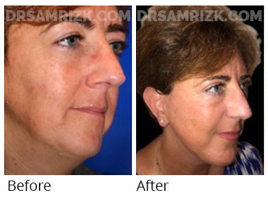 1 year after deep plane facelift and deep neck lift in this 60 yo patient
