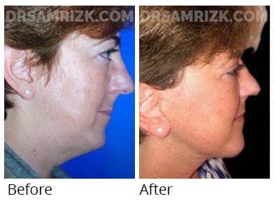 1 year after deep plane facelift and deep neck lift in this 60 yo patient