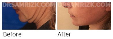 Female face, before and after Facelift, oblique view, patient 49
