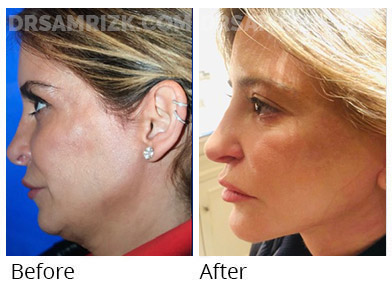 45 yo patient shown 6 weeks after deep plane facelift / deep neck lift / platysmaplasty & fat transfer cheeks
