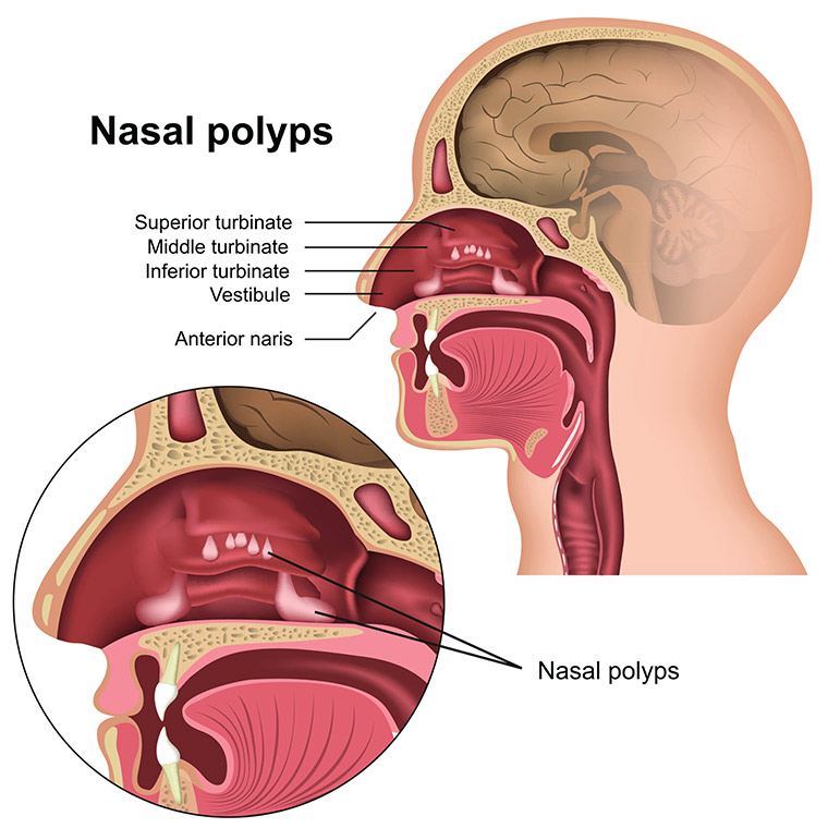 nasal polyps photo