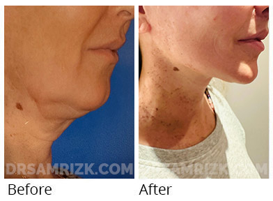 52 yo patient shown 1 year after extended deep plane facelift / deep neck lift and lip lift . She had a recent laser to neck as well hence discoloration.