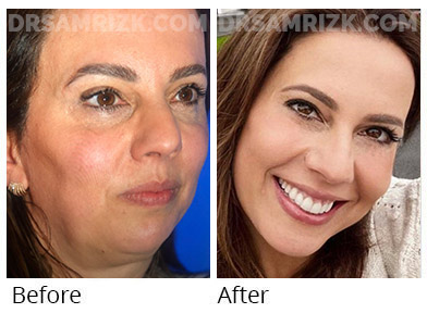 52 yo patient sent these pictures 2 months post vertical deep plane facelift / deep necklift / upper blepharoplasty / temporal browlift / rhinoplasty / laser looking refreshed and natural. She now looks like herself in mid-30’s