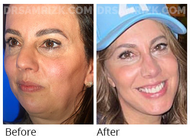 52 yo patient sent these pictures 2 months post vertical deep plane facelift / deep necklift / upper blepharoplasty / temporal browlift / rhinoplasty / laser looking refreshed and natural. She now looks like herself in mid-30’s