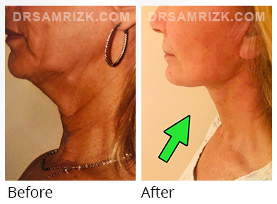 Female face, before and after Facelift, side view, patient 58