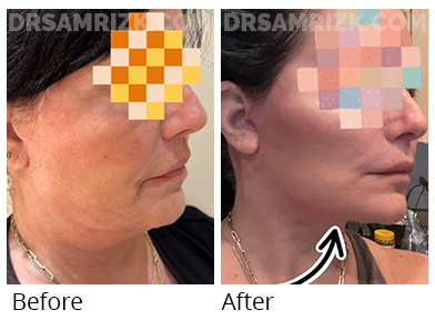 Patient is shown 1 month after revision deep plane facelift / necklift . Her previous facelift had failed only 1 year prior with heavy jowling / neck laxity and a cobra deformity . Patient is thrilled with her new jawline