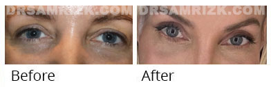 History 39 yo wife of nyc plastic surgeon Dr. Ryan Neinstein underwent upper and lower blepharoplasty for redundant skin and bags shown at different stages of healing. Last 2 pictures patient sent 1 month after.