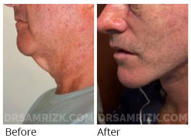 55 yo patient who lost significant weight underwent deep plane facelift/ deep necklift shown 13 hours after surgery with no drain with rapid recovery tissue glue protocol Dr Rizk pioneered.