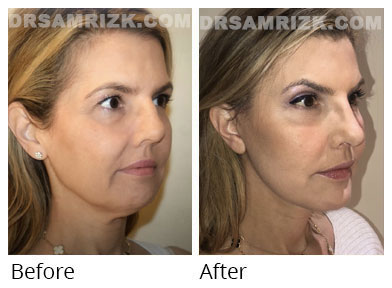 Female face, before and after Facelift treatment, front view, patient 50