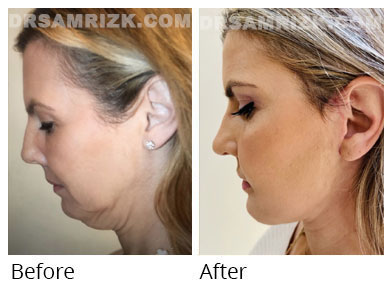 Female face, before and after Facelift  treatment, side view, patient 50