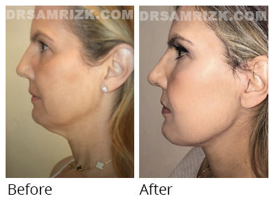 Female face, before and after Facelift treatment, patient 50