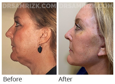 This patient underwent revision deep plane facelift / deep necklift / Buccal fat removal to define her jawline & repair of pixie ear deformity & is show 1 week after . This is not final result and she will continue to heal and scars will continue to improve.