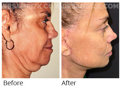 55 yo female shown 3 months post deep plane facelift / deep necklift to define jawline . Incisions look great and will continue to heal for up to a year .