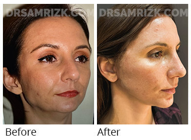 40 yo patient shown 2 weeks after deep plane facelift / deep necklift and rhinoplasty . She looks natural and has a better jawline than she ever had even when she was in her 20’s. Incisions are healing and will continue to improve. Healing varies individually - some patients bruise & swell more than others. No drain was used and tissue sealant was used to reduce bruising and swelling.