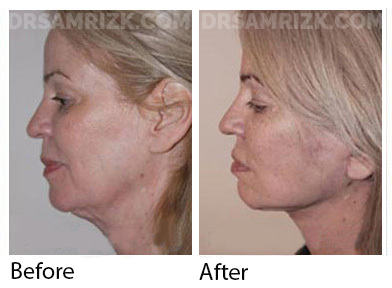 Female face, before and after Facelift and necklift treatment, l-side view, patient 42