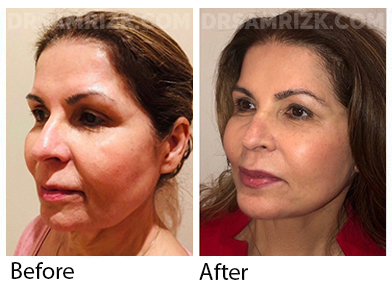 Female face, before and after Facelift, front view, patient 49