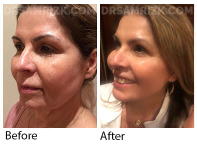 Female face, before and after Facelift, oblique view, patient 49