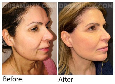 Female face, before and after Facelift, side view, patient 49