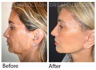 66 yo patient looking amazing 6 months after deep plane facelift / deep necklift / platysmaplasty / temporal browlift and fat transfer to cheek area / lower eyelids . Patient has great jawline and youthful cheeks looks 20 years younger
