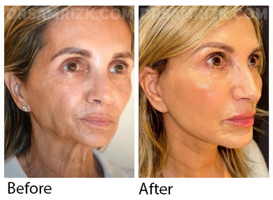 66 yo patient looking amazing 6 months after deep plane facelift / deep necklift / platysmaplasty / temporal browlift and fat transfer to cheek area / lower eyelids . Patient has great jawline and youthful cheeks looks 20 years younger