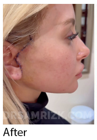 28 yo patient who lost excessive weight over 100 lb and underwent rapid recovery deep plane facelift / necklift and buccal fat reduction and is shown 1 week post surgery. Patient had no drains and had tissue glue instead to expedite recovery as part of our rapid recovery protocol . Dr rizk does not evaluate facelift patients based on age but rather based on aging and degree of laxity or looseness.