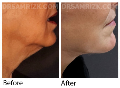 67 yo patient 6 months after deep plane facelift and neck platysmaplasty midline to tie cords
