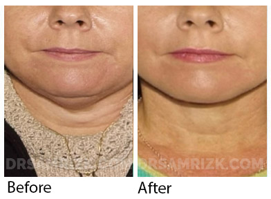 53 yo patient shown 2 years after deep plane facelift / deep neck lift and midline platysmaplasty showing jawline definition & elimination of the square jowling that occurs with descent of jowls with aging