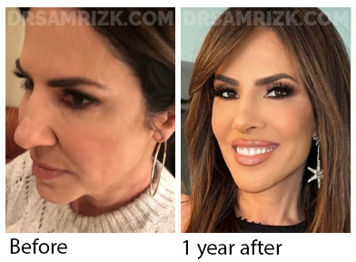Female face, before and after Facelift, side view, patient 48