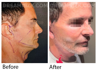 55 yo male sent his own pictures at 3 days post revision deep plane facelift / deep necklift / midline platysmaplasty . Patient shown on video at 1 week post . Previous failed smas lift was done 1 year prior.