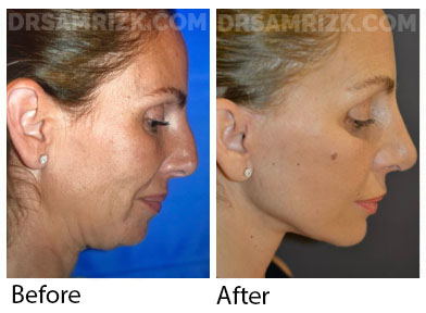 55 yo patient shown 6 months after deep plane facelift /deep necklift / midline platysmaplasty / fat transfer to lower eyes and rhinoplasty.