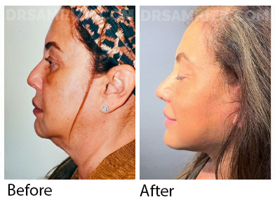 Patient is 2 weeks post deep plane facelift / deep necklift. Although she is still swollen and still healing , it shows jawline definition and the rapid recovery of Dr Rizk drainless facelift with tissue glue.
