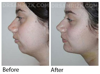 Female face, before and after Facelift and necklift treatment, l-side view, patient 38