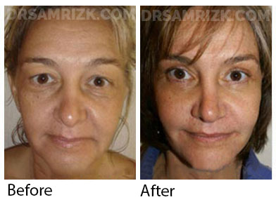 Female face, before and after Facelift and necklift treatment, front view, patient 41