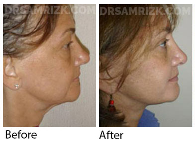 Female face, before and after Facelift and necklift treatment, l-side view, patient 41