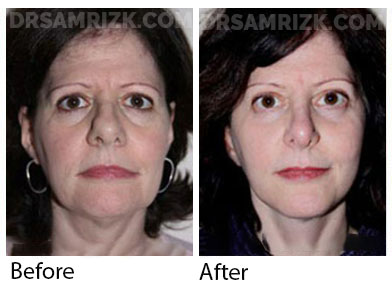 Female face, before and after Facelift and necklift treatment, front view, patient 7