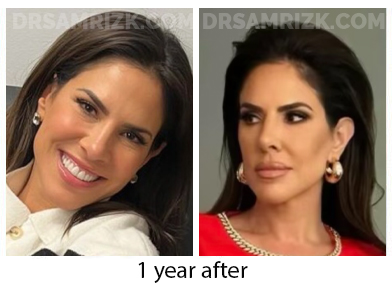 Female face, before and after Facelift, front view, patient 48