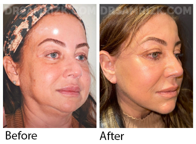 Patient is 2 weeks post deep plane facelift / deep necklift. Although she is still swollen and still healing , it shows jawline definition and the rapid recovery of Dr Rizk drainless facelift with tissue glue.