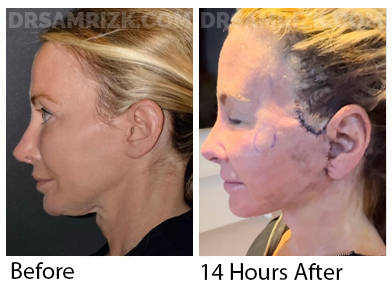 52 yo patient shown after deep plane facelift / deep necklift / fat transfer to cheeks and laser. She had a history of nerve damage from a thread lift. The threads were also removed during Dr Rizk’s surgery which eliminated her nerve problem. Patient is an out of town patient who traveled to New York from Grand Cayman Islands . She stayed in New York 2 weeks post. Out of town patients are required to stay 2 weeks post surgery. We also require private nursing which we arrange for 48 hours post and sometimes hyperbaric oxygen for a faster recovery.