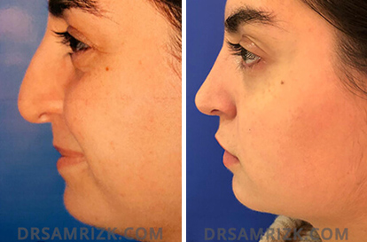 Rhinoplasty New York, Nose Job NYC Surgeon, Septoplasty Sinus Surgery