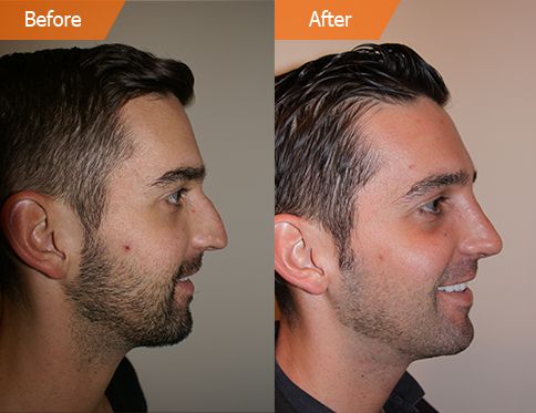 Male face, Before and After Plastic Surgery Treatment, left side view, patient 1
