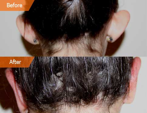 before and after Otoplasty - back view