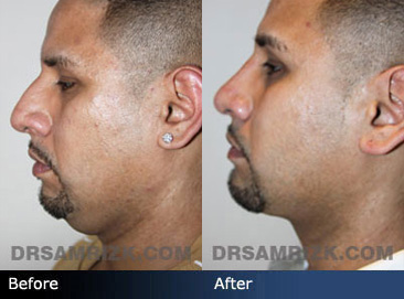 Male Facelift Surgery | Face Lift for Men