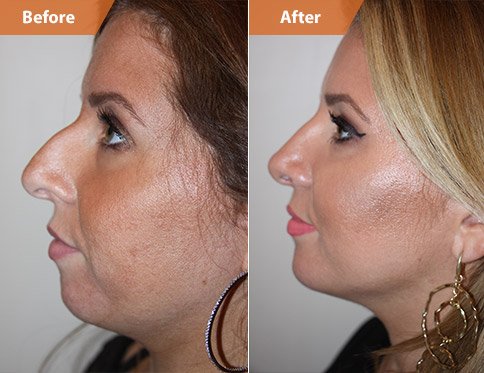 chin reduction surgery female