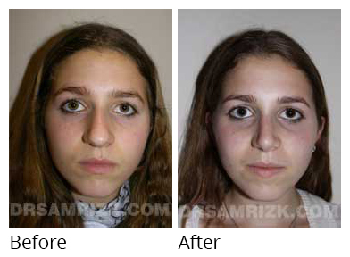Female face, before and after Rhinoplasty treatment, front view, patient 10